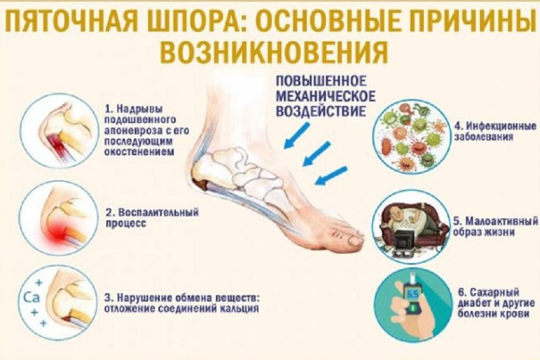 Пяточная шпора – симптомы и лечение - Промедклиник в Нижнем Новгороде